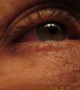 dark circles, red eye,m accentuated wrinkles